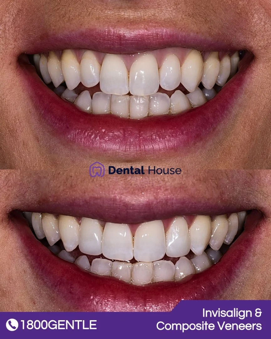 Invisalign &#; Composite Veneers