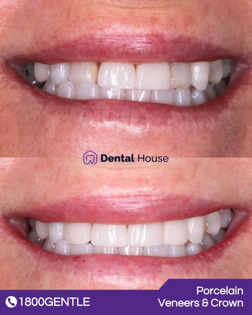 Porcelain Veneers &#; Crown