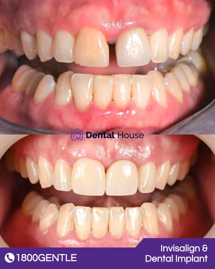 Invisalign &#; Dental Implant