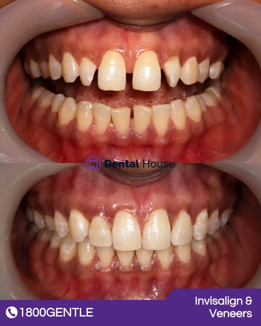 Invisalign &#; Veneers