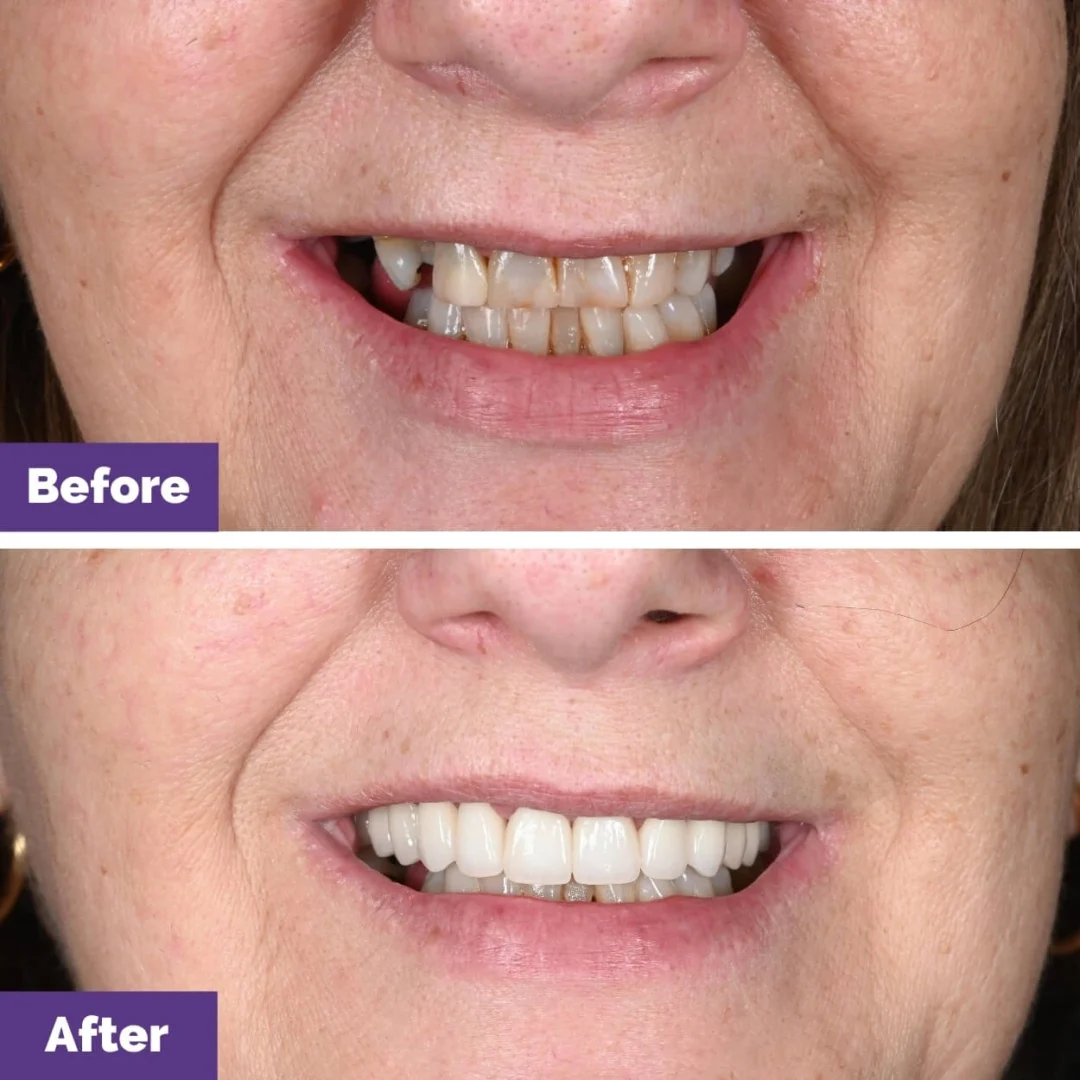 Porcelain Bridge Veneers Gap Closure Case