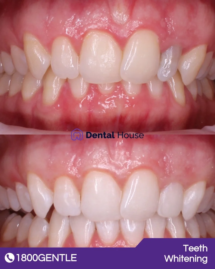 Invisalign &#; Teeth Whitening