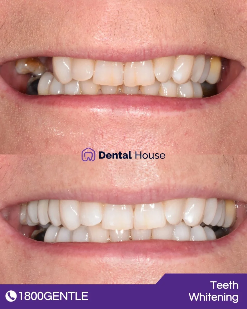 Teeth Whitening &#; Dental Implant