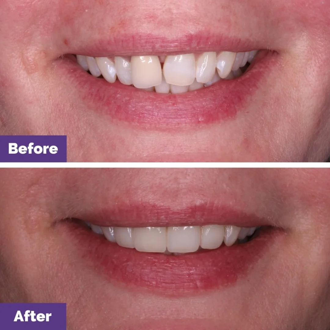 Veneers Crowns Short Teeth Case Study